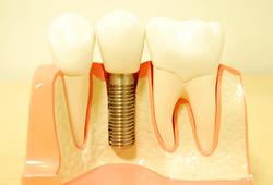 インプラントとは