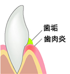 歯肉炎