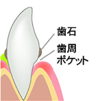 軽度歯周炎