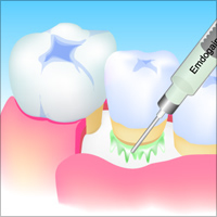 エムドゲインを利用した歯周病治療法