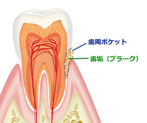 歯周病について